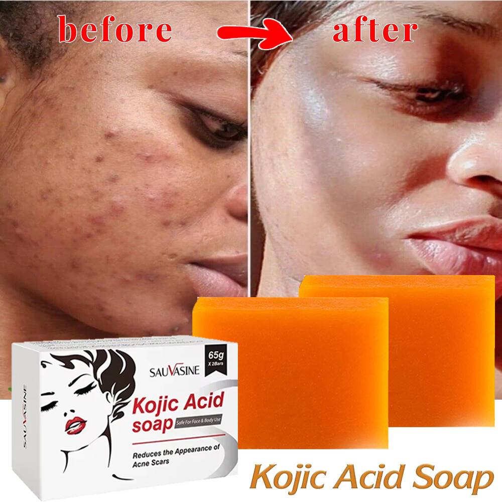 5/3X Kojic Acid Soap Acne Dark Spot Remover Skin Lightening Whitening Face Body