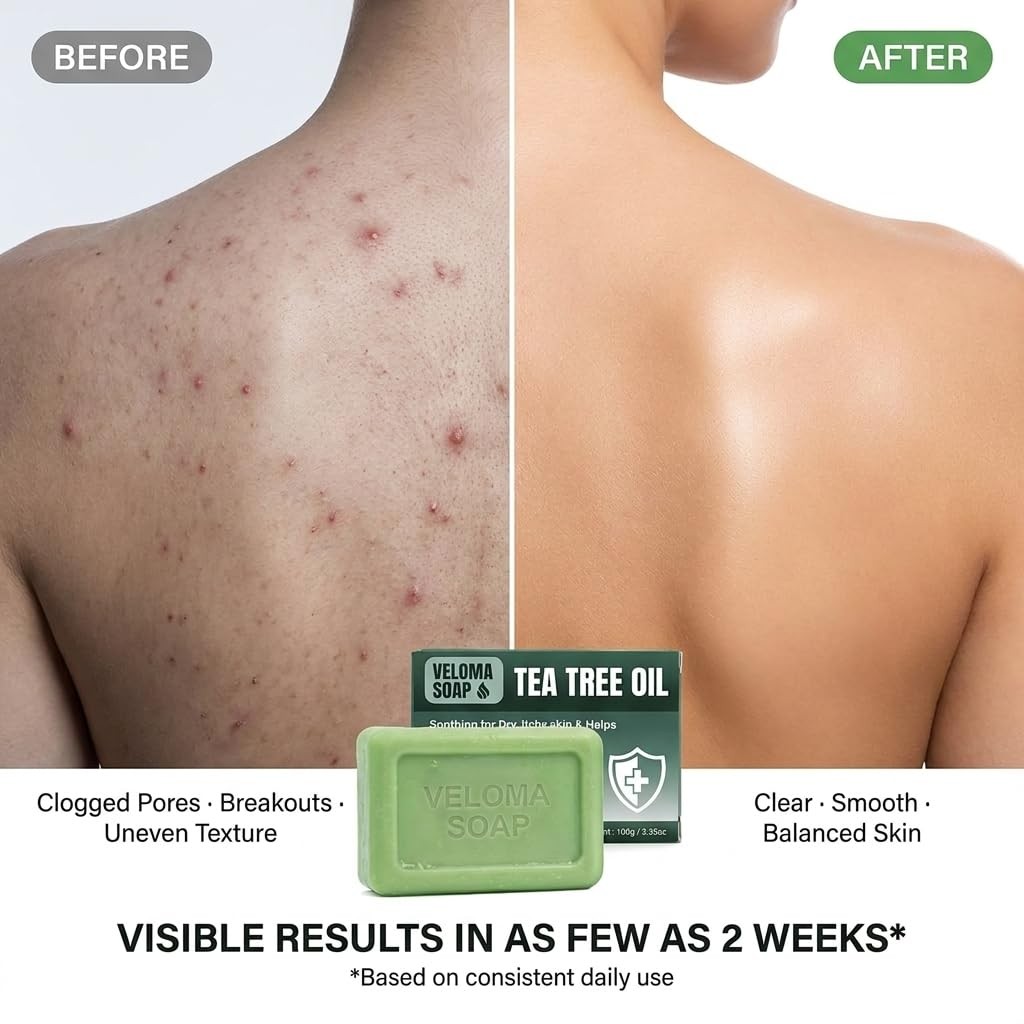 Official Veloma Antifungal Soap,Veloma Soap,with Tea Tree Oil & Coconut Oil &…