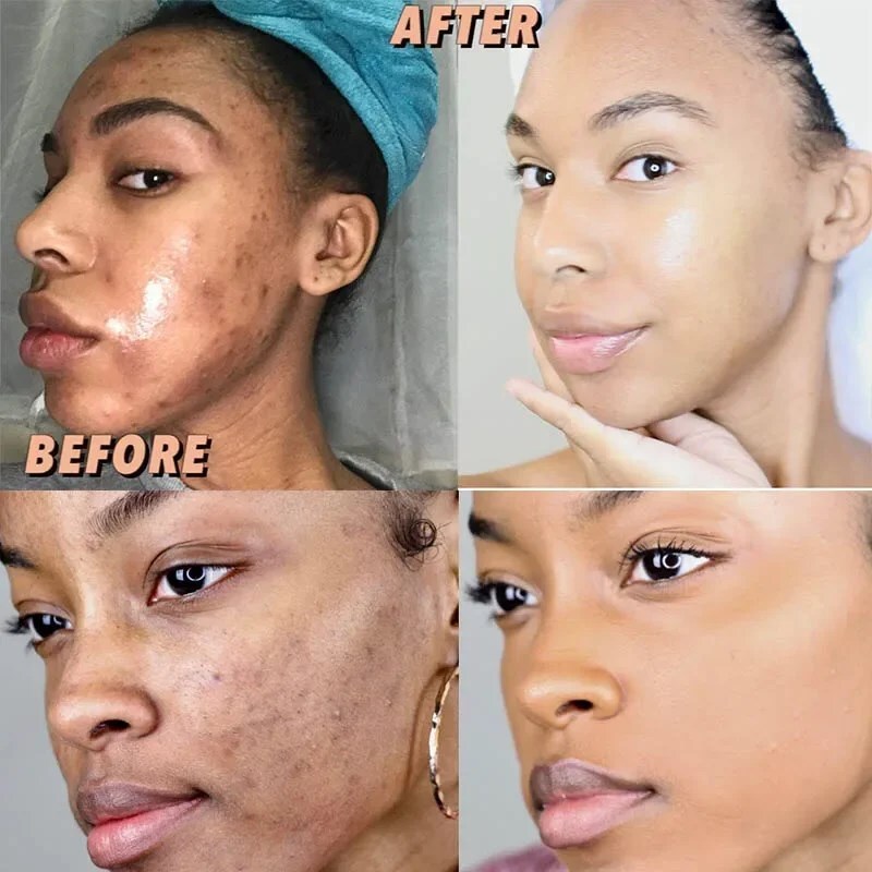 Kojic Acid Dark Spot Remover Soap Bars with Vitamin C Retinol, Collagen Turmeric