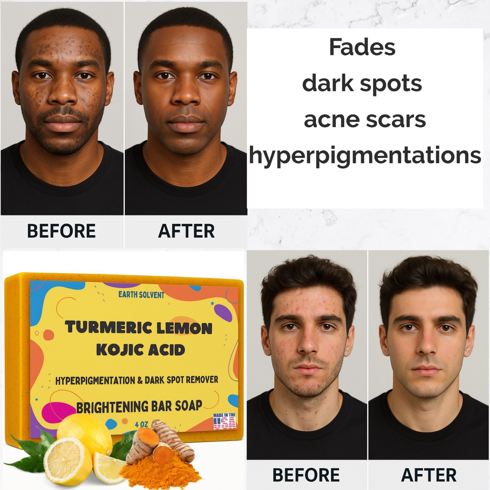 Kojic Acid Soap Dark Spot Whitening Turmeric Skin Bleaching Lightening 4oz – 3PK