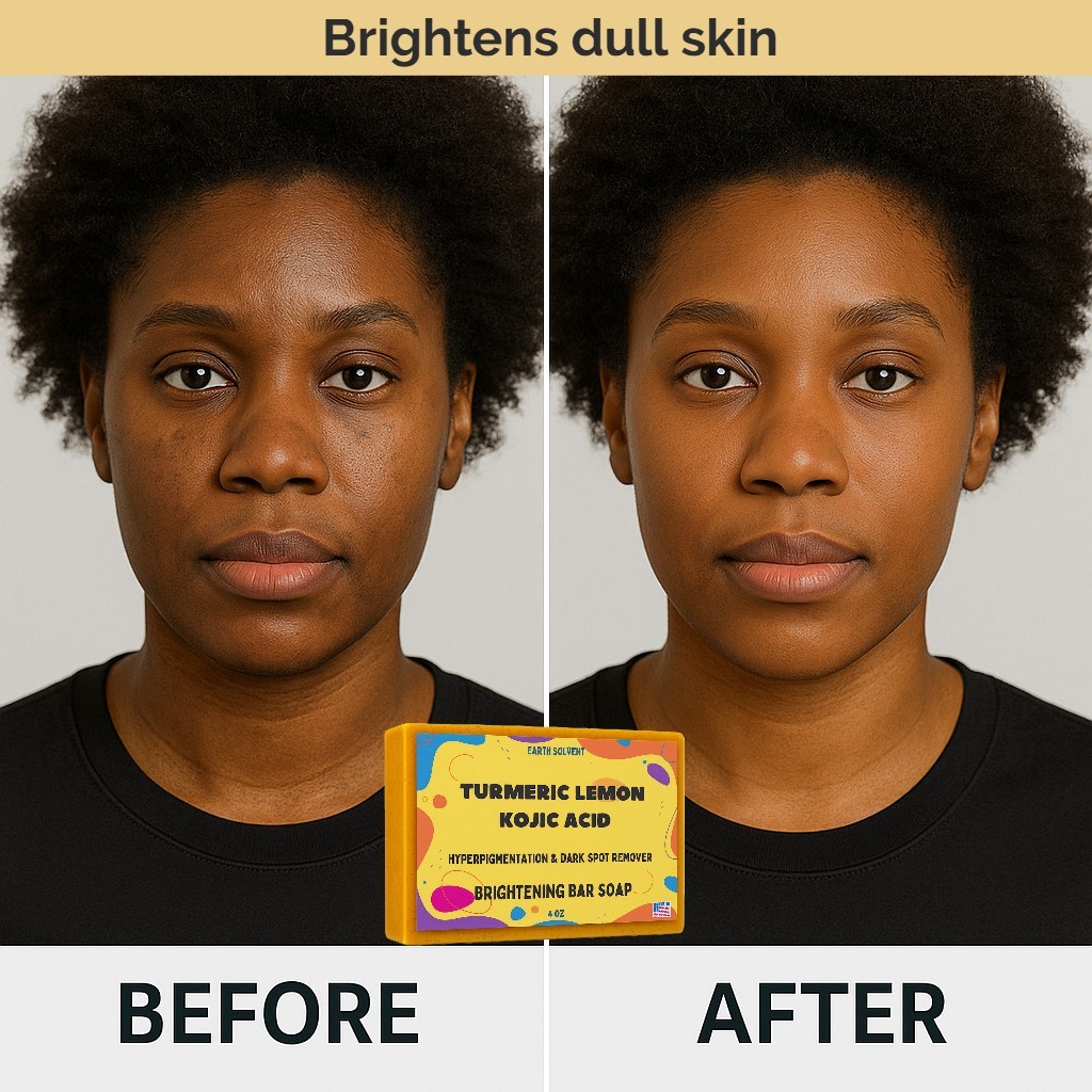 Kojic Acid Soap Dark Spot Whitening Turmeric Skin Bleaching Lightening 4oz – 3PK