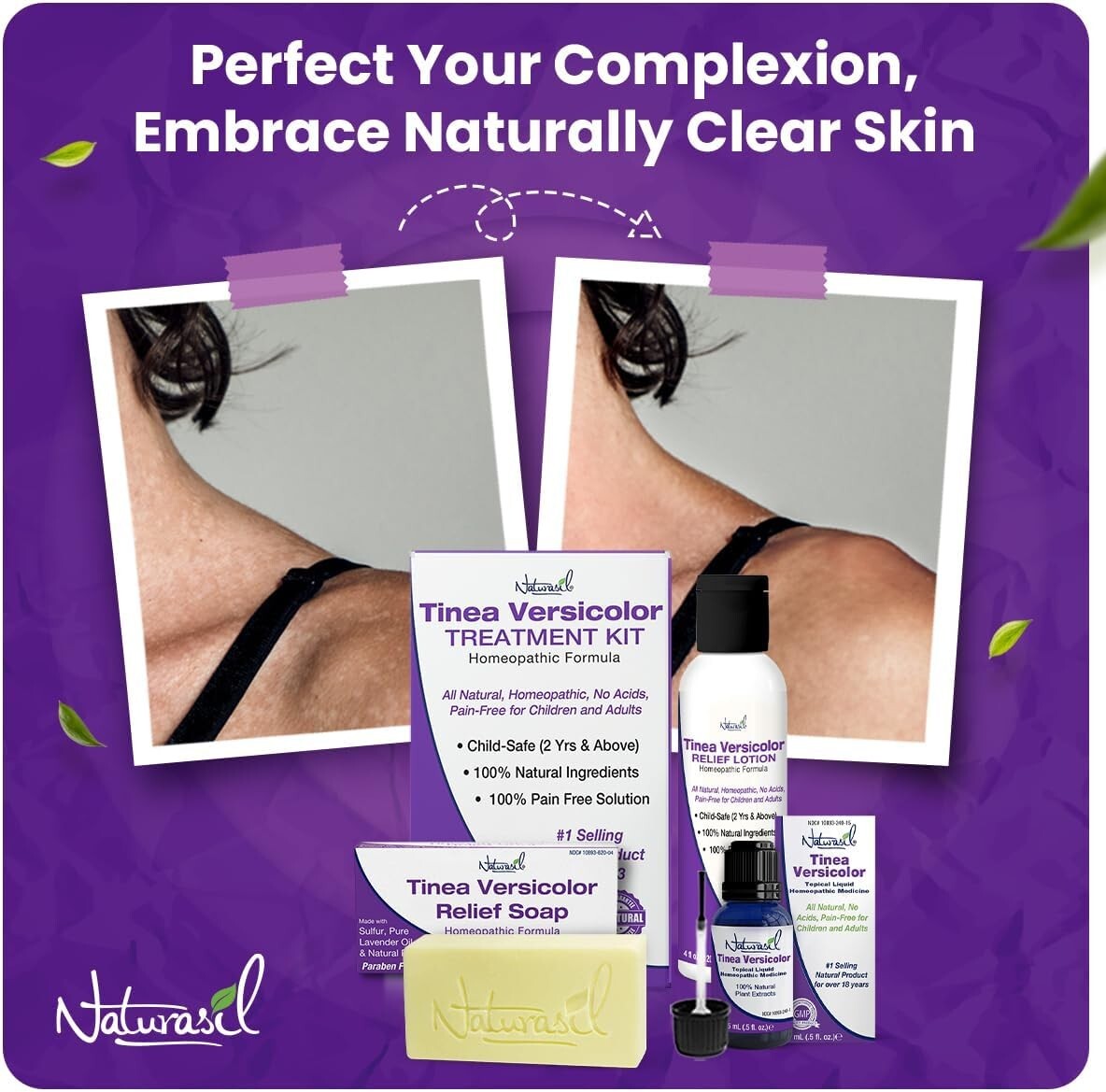 Effective Tinea Versicolor Treatment Max-Strength Soap: Fast-Acting, Kid Safe