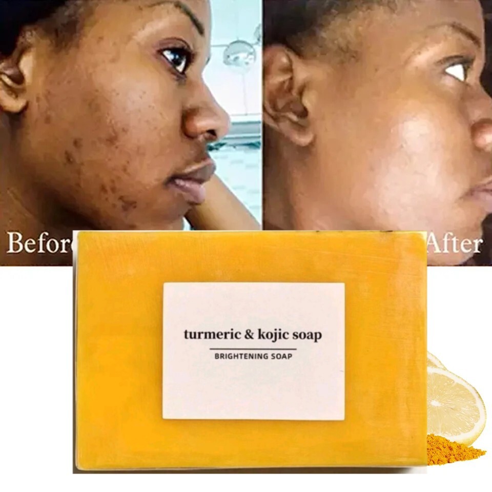 Tumeric Lemon + Kojic Acid Soap Skin Whitening Dark Spot 3.53oz