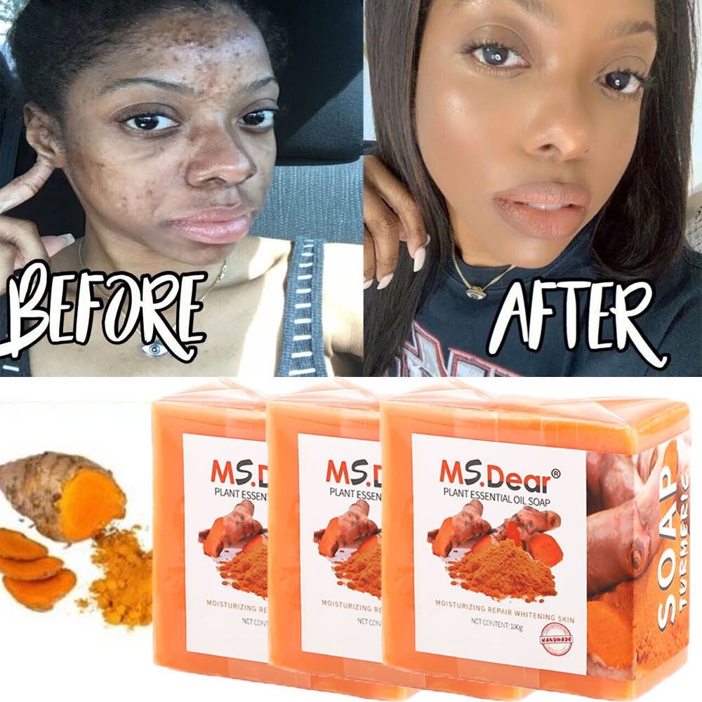 3/1x Tumeric Soap Skin Whitening Dark Spots lightening Acne Brightening Turmeric