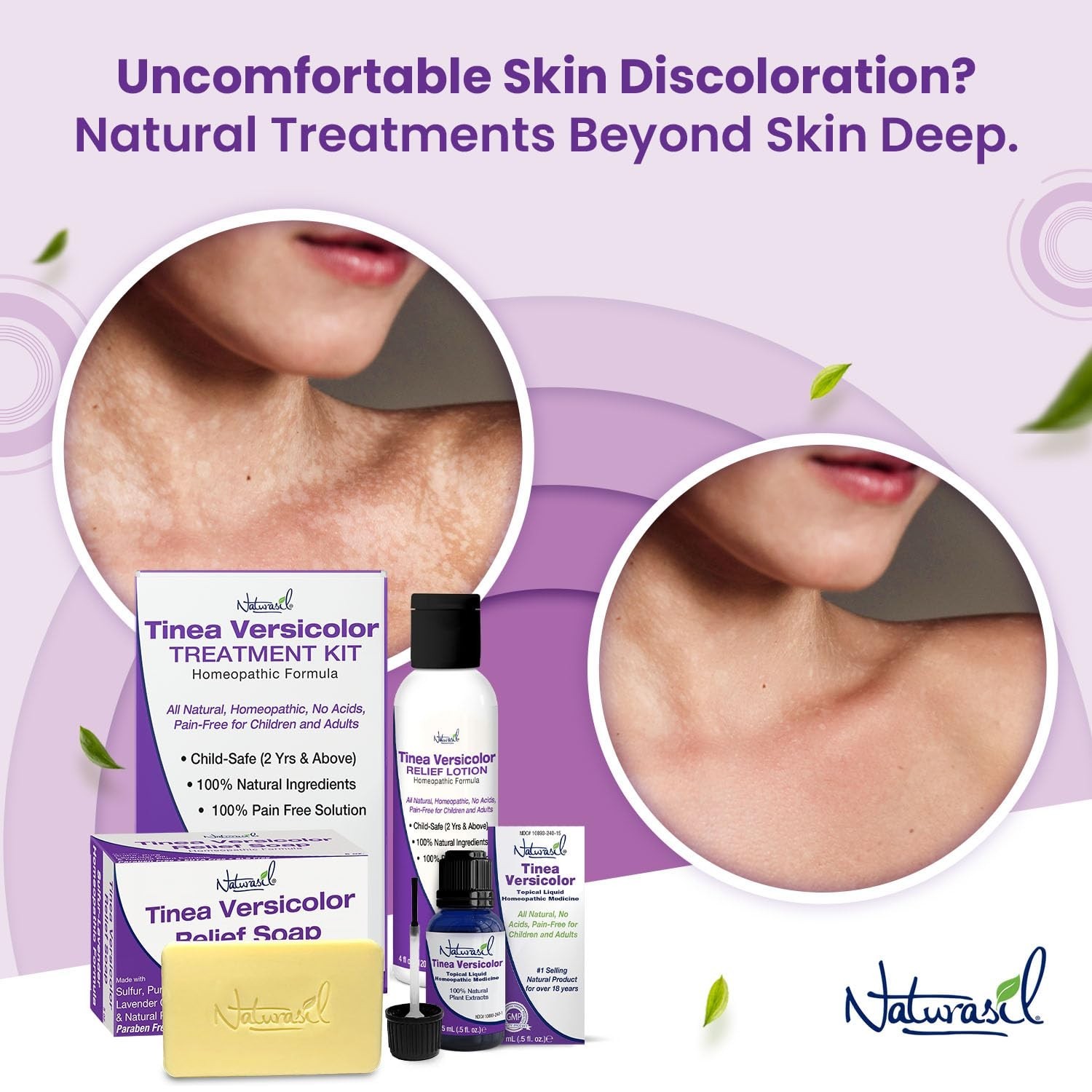 Natural Tinea Versicolor Soap 2-Pack | Lavender Scent, Skin Soothing Formula