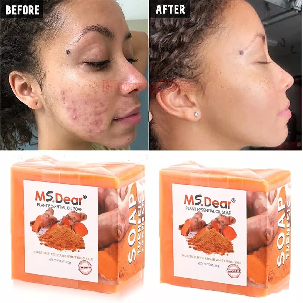 20X Tumeric Soap Skin Whitening Dark Spots lightening Acne Brightening Turmeric