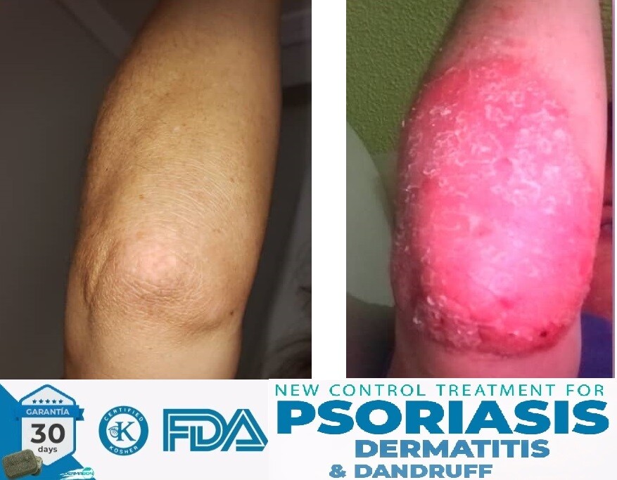 Psoriasis, Seborrheic Dermatitis and Dandruff Soap Dermabon FREE SHIPPING