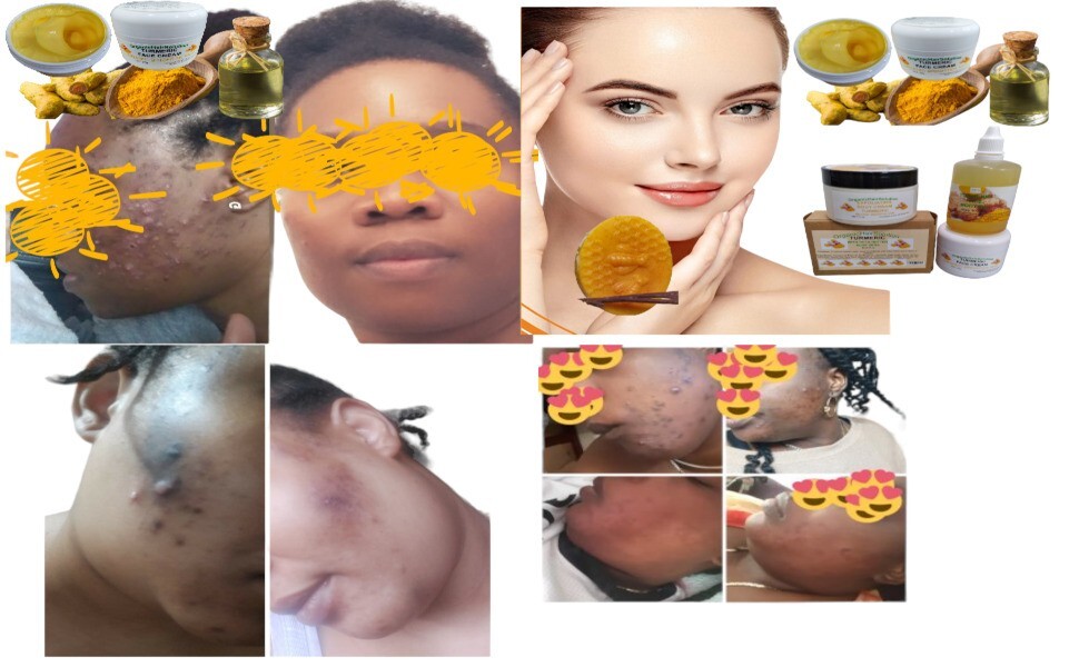 Turmeric Bar Soap Face With Aloe Vera& Ginger | Reduces Dark Spots &Fades Scars