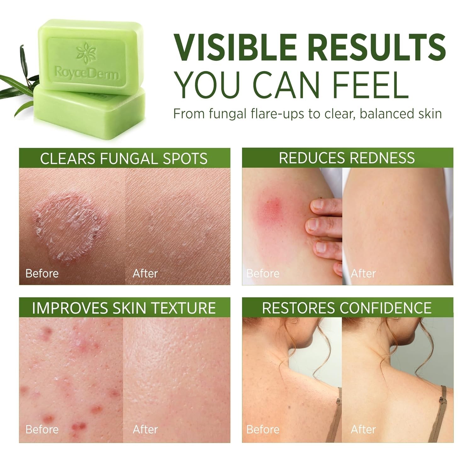Antifungal Antibacterial Tea Tree Soap: Antifungal Antibacterial Treat
