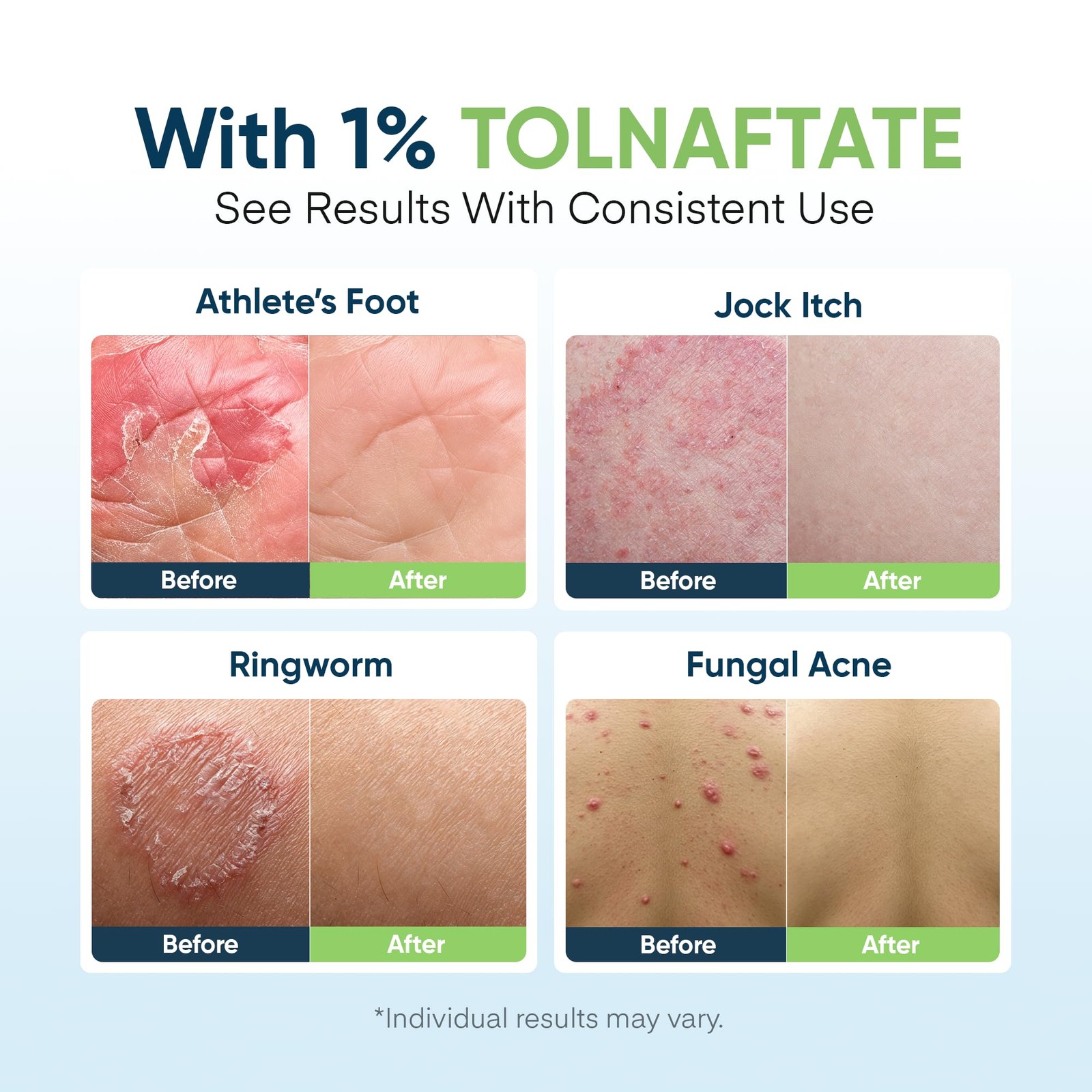 Antifungal Soap Bar with Tea Tree Oil & Charcoal, 16.9 Fl Oz (Pack of 1)