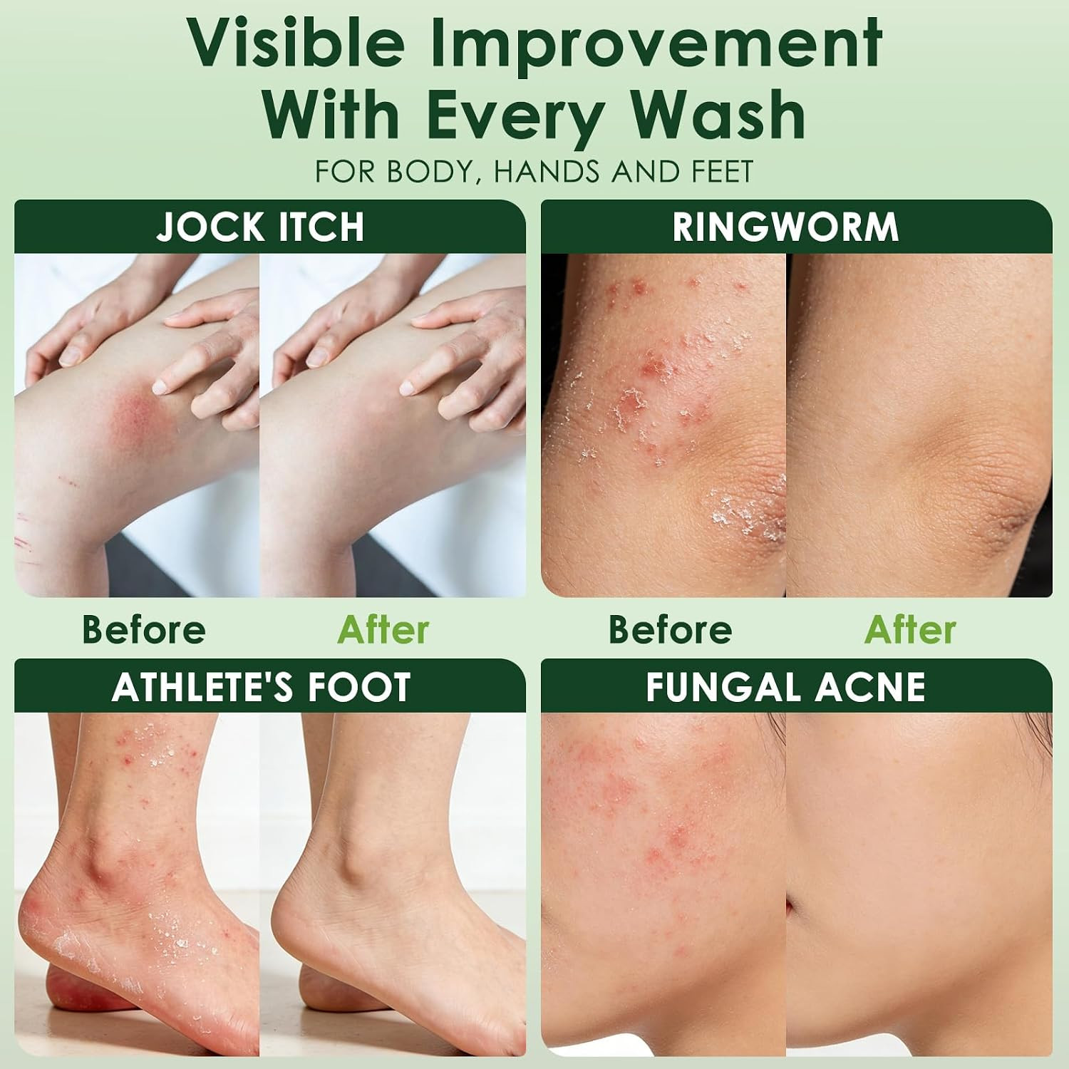 Antifungal Soap Tea Tree Antifungal Soap Bar for Back Acne Athlete’S Foot, Tinea