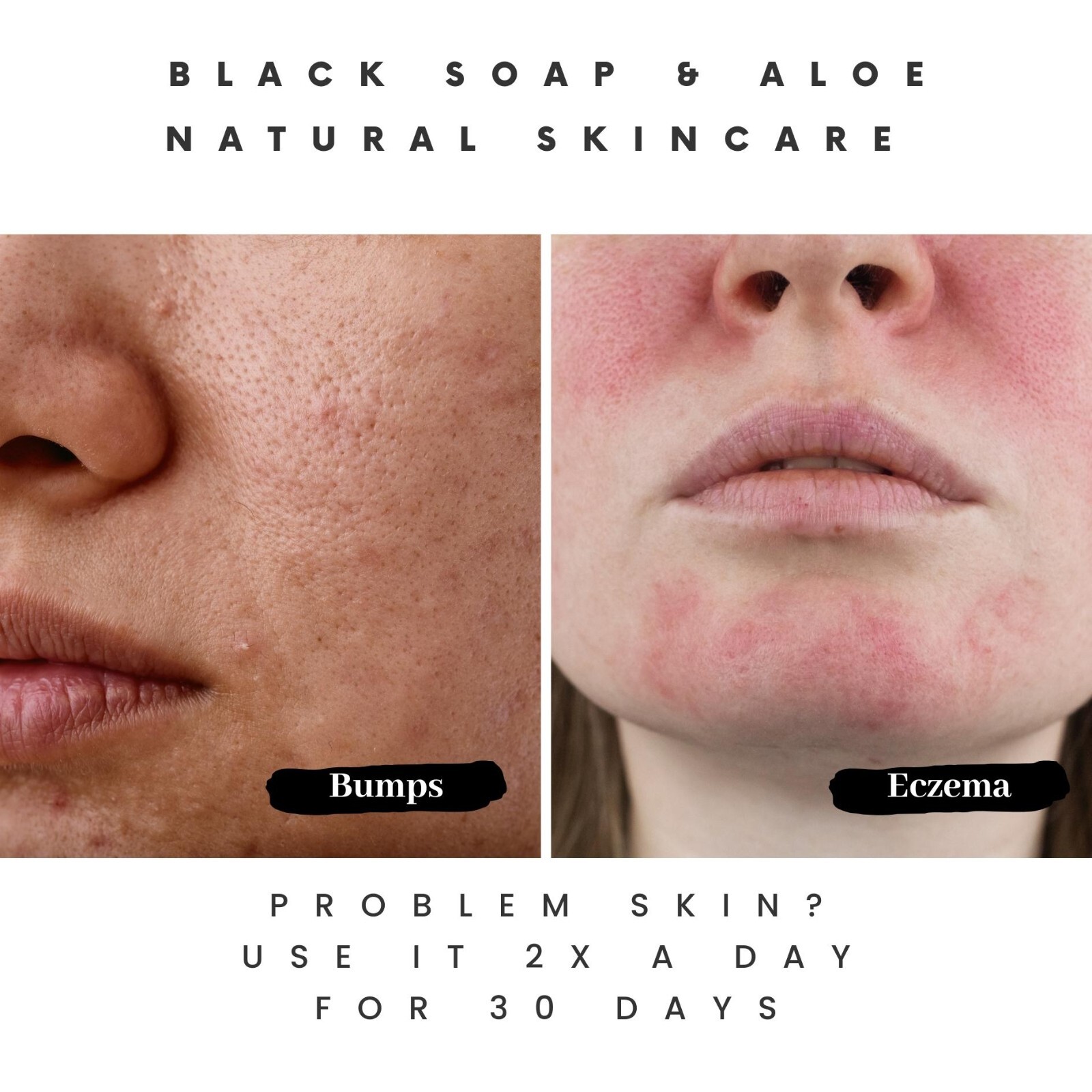 How Pimple Soap Can Improve Your Skin Health