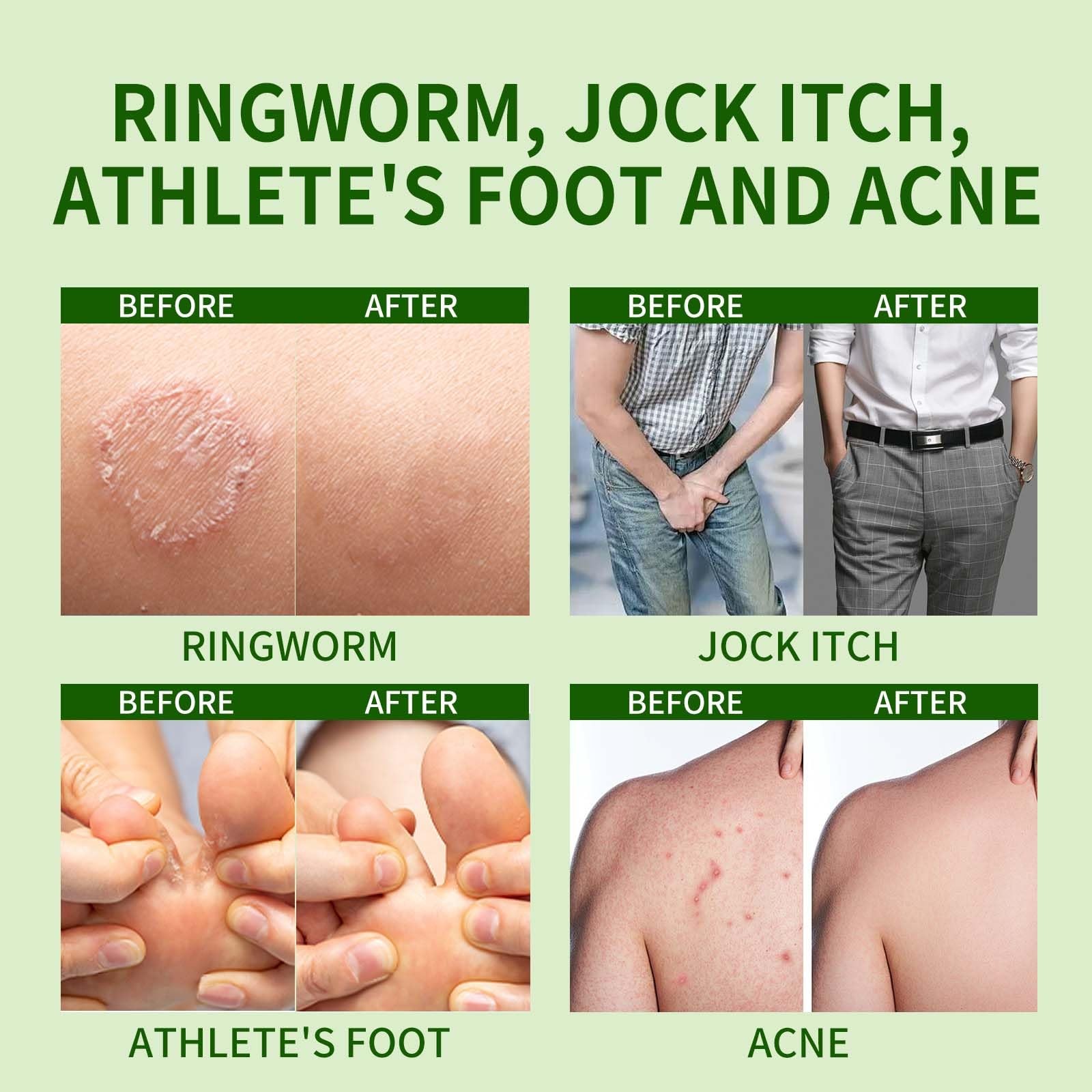 Antifungal Bar Soap Skin Fungus Treatment for Athlete’s Foot, Jock Itch & Ri…