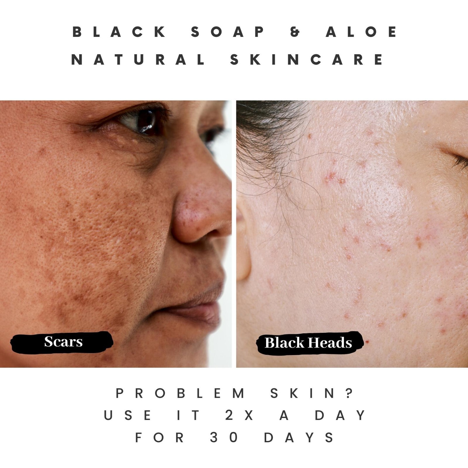 How Pimple Soap Can Improve Your Skin Health