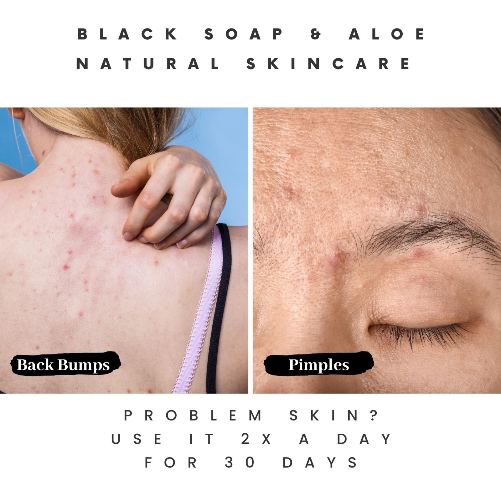 How Pimple Soap Can Improve Your Skin Health