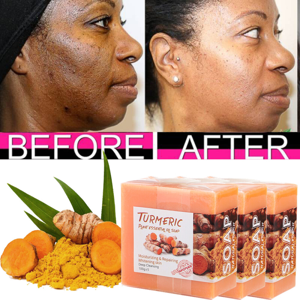 3/2X Turmeric Soap Dark Spot Corrector Serum Acne Melasma Remover Whitening Face