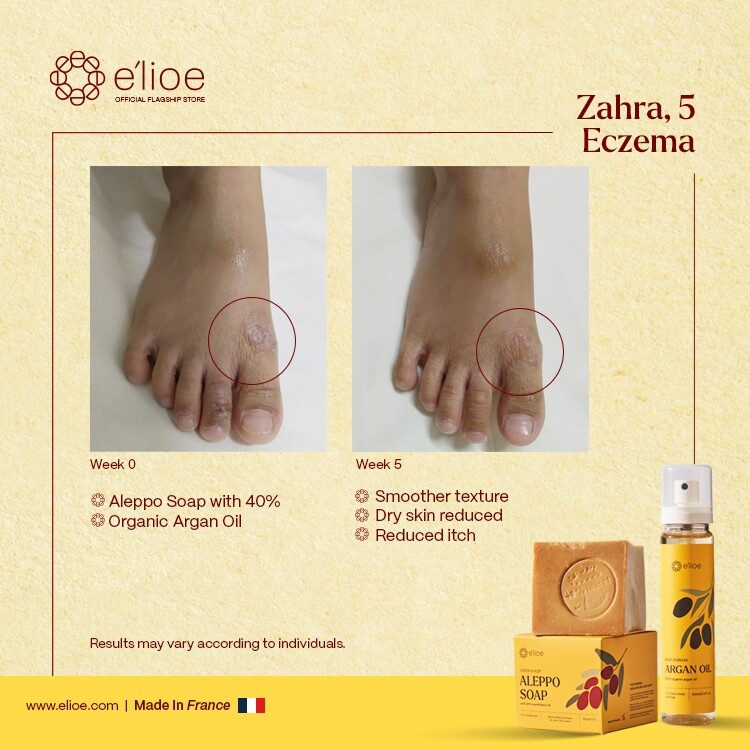 e’lioe Soap Laurel Berry Oil 2-Step Solution for ECZEMA Trouble Skin-200g – DHL