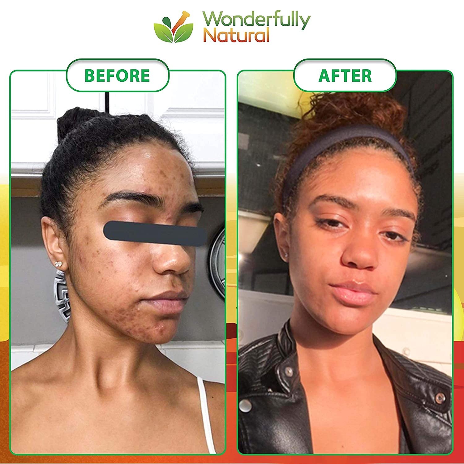 #1 African Black Soap for Acne & Dark Spots | Organic Vegan Satisfaction Guar…