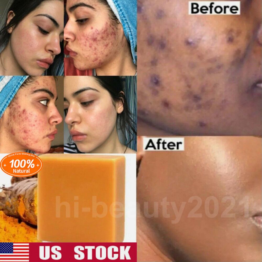 2× Tumeric Soap Skin Whitening Dark Spots lightening Acne Brightening Turmeric