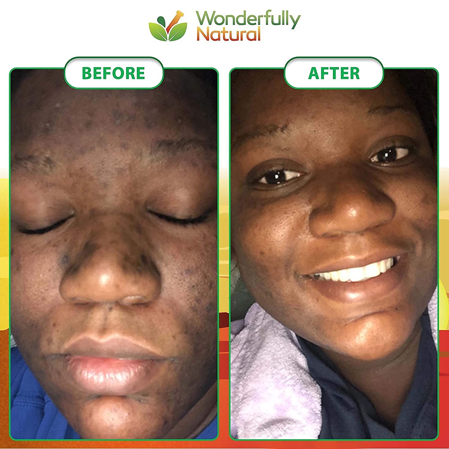 #1 African Black Soap for Acne & Dark Spots | Organic Vegan Satisfaction Guar…