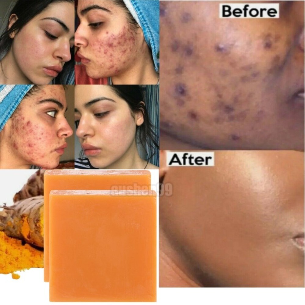 2× Tumeric Soap Skin Whitening Dark Spots lightening Acne Brightening Turmeric