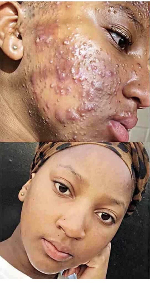 2pc Turmeric Soap Skin Whitening Dark Spots lightening Acne Brightening Turmeric