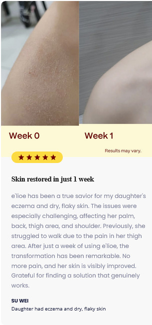 e’lioe Soap Laurel Berry Oil 2-Step Solution for ECZEMA Trouble Skin-200g – DHL