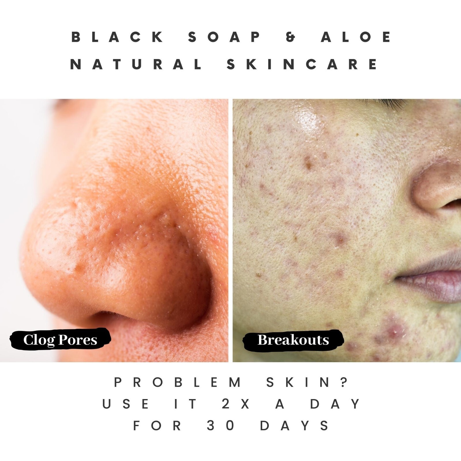 How Pimple Soap Can Improve Your Skin Health