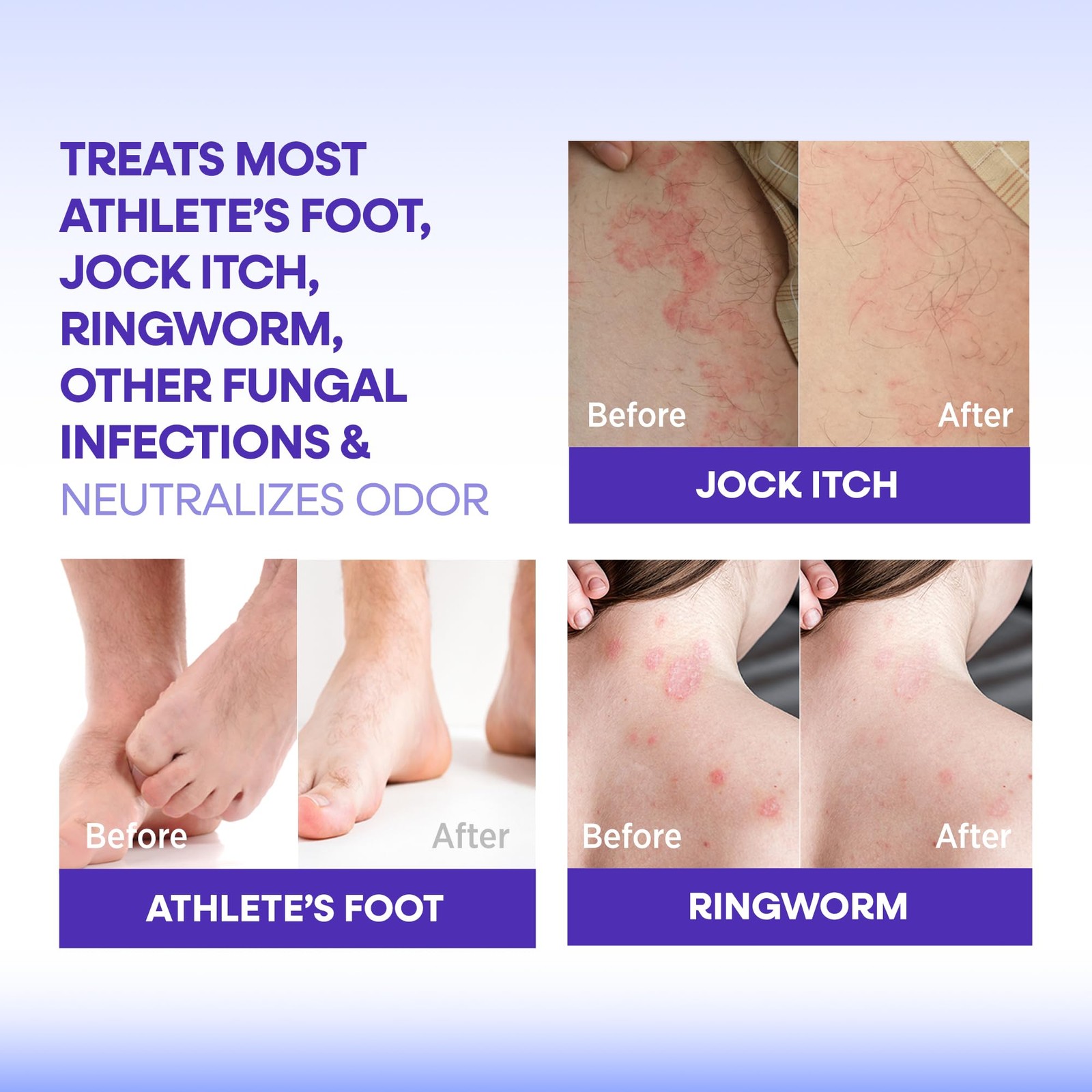 Hermon Antifungal Bar Soap: Antifungal Soap for Ringworm, Jock Itch & Athlete’s
