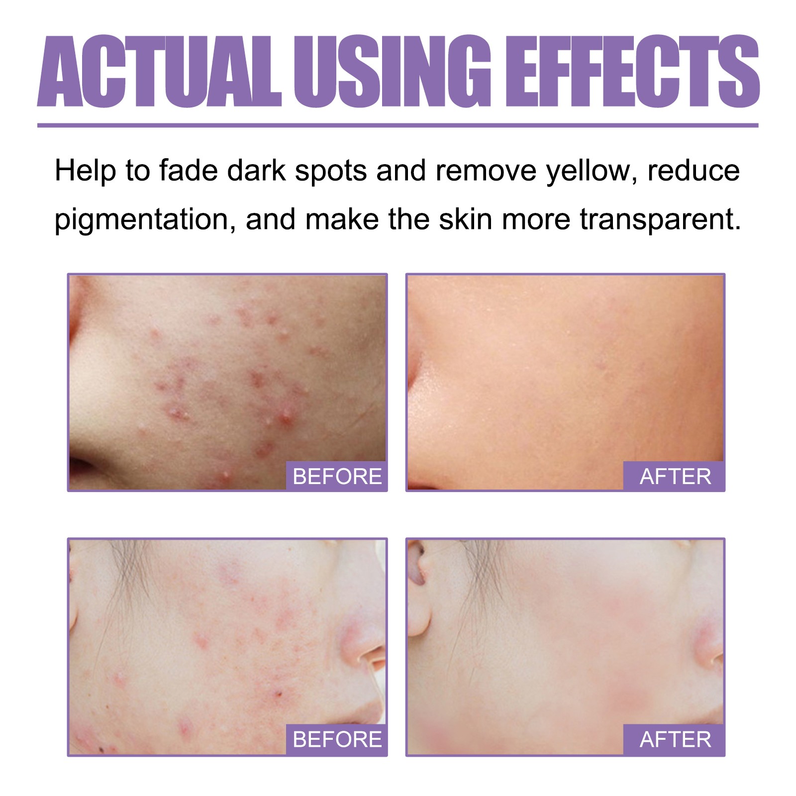 Lavender Acne Soap, Oil Control & Brightening, Vitamin C Face Soap