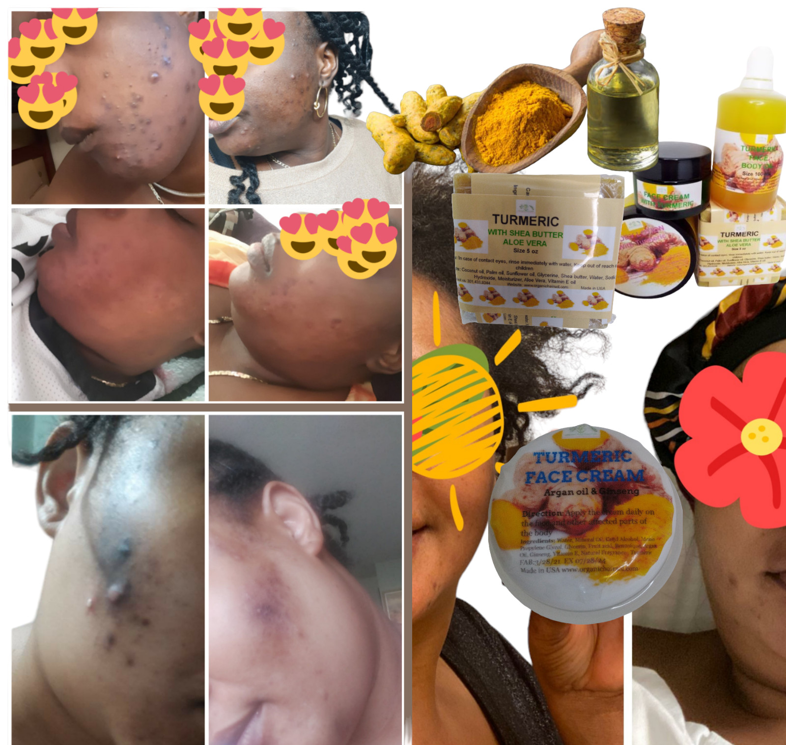 Turmeric Bar Soap Face With Aloe Vera& Ginger | Reduces Dark Spots &Fades Scars