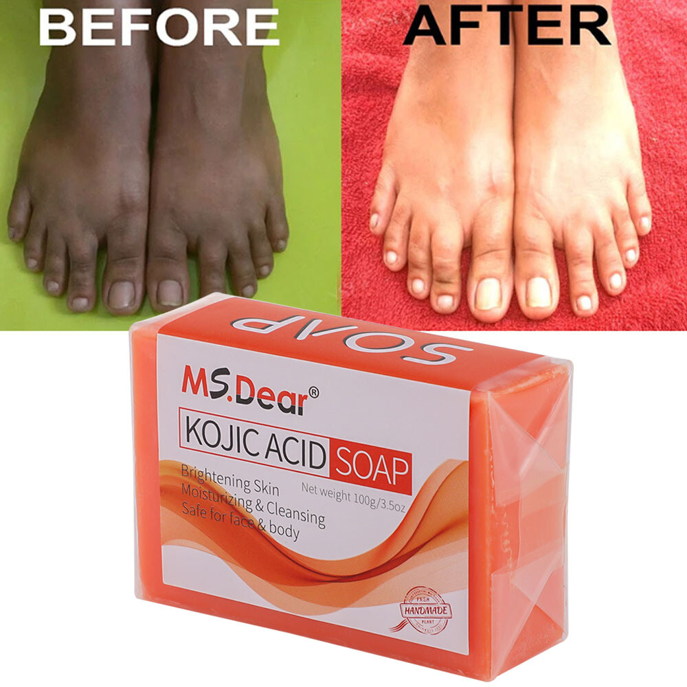 5-1X Kojic Acid Soap Acne Dark Spot Remover Skin Lightening Whitening Face Body