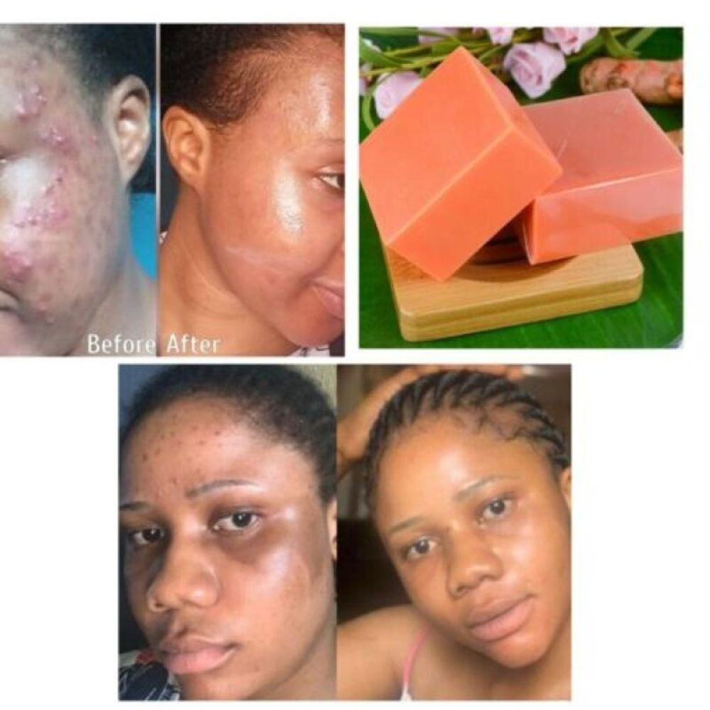 8Pcs Turmeric Soap Anti Acne Skin Whitening Face & Body Dark Spots Removal 100g