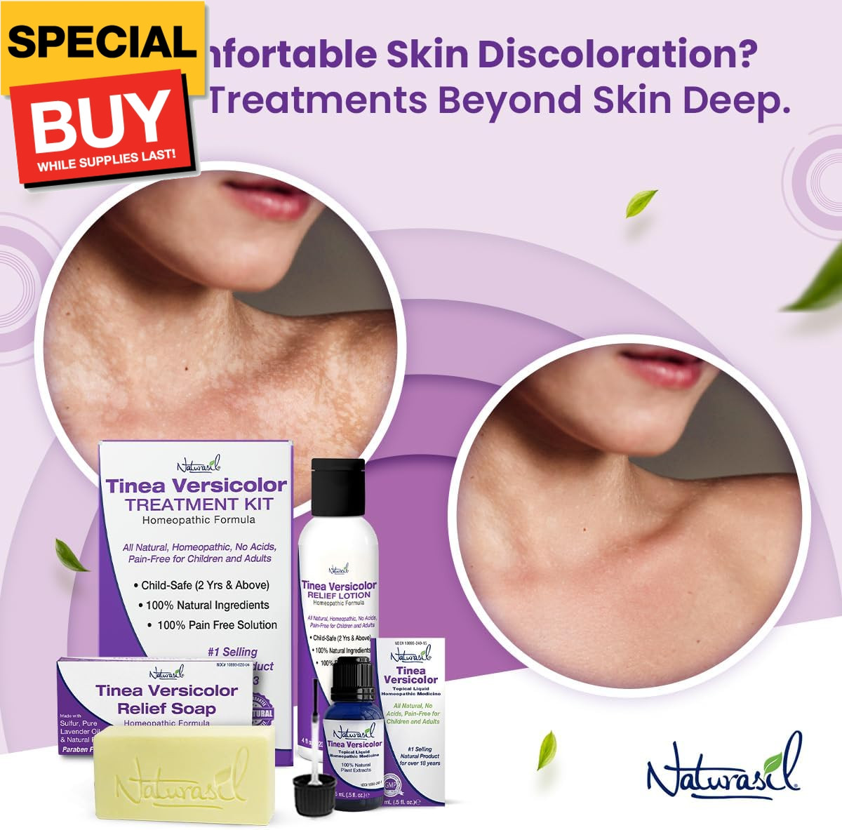 Tinea Versicolor Treatment Max-Strength 10x Soap | Antifungal Micronized Sulfur