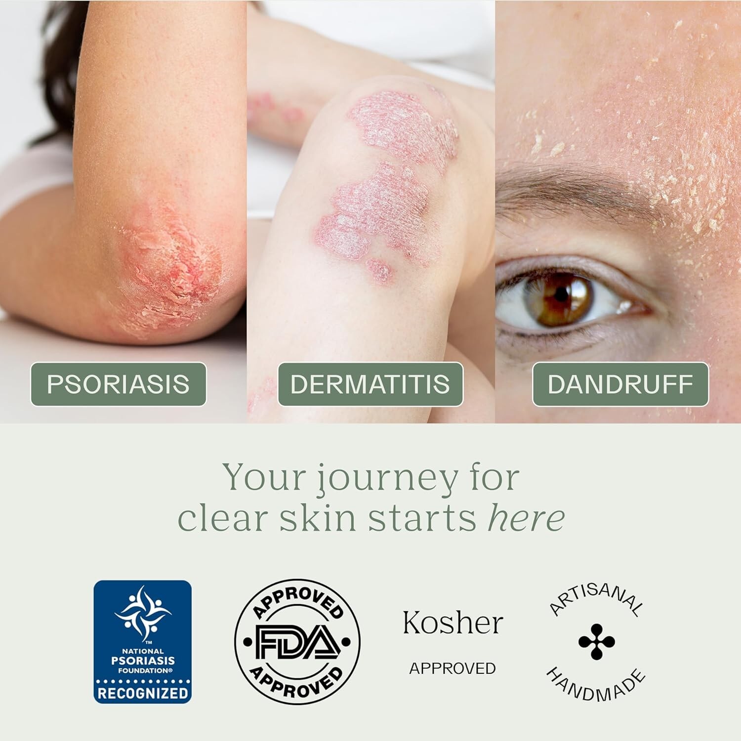 Intensive Relief Soap Bar for Psoriasis & Eczema – 3 Pack, Moisturizing Formula=
