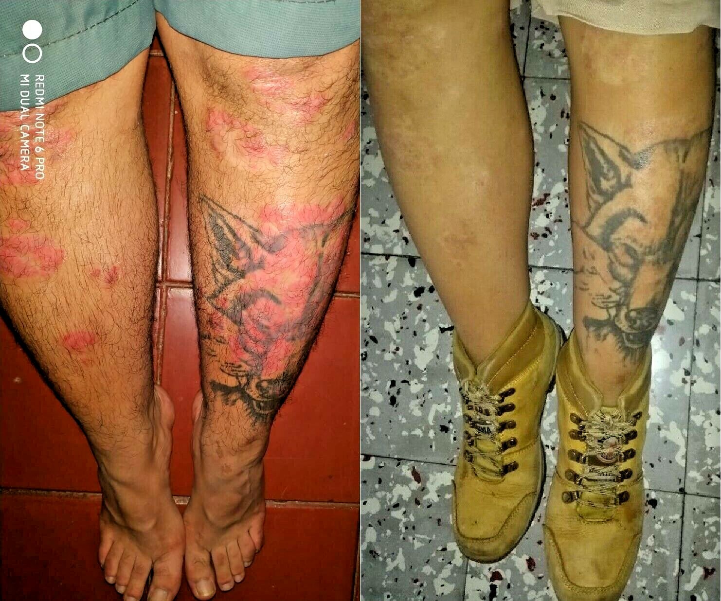 Psoriasis, Seborrheic Dermatitis and Dandruff Soap Dermabon FREE SHIPPING