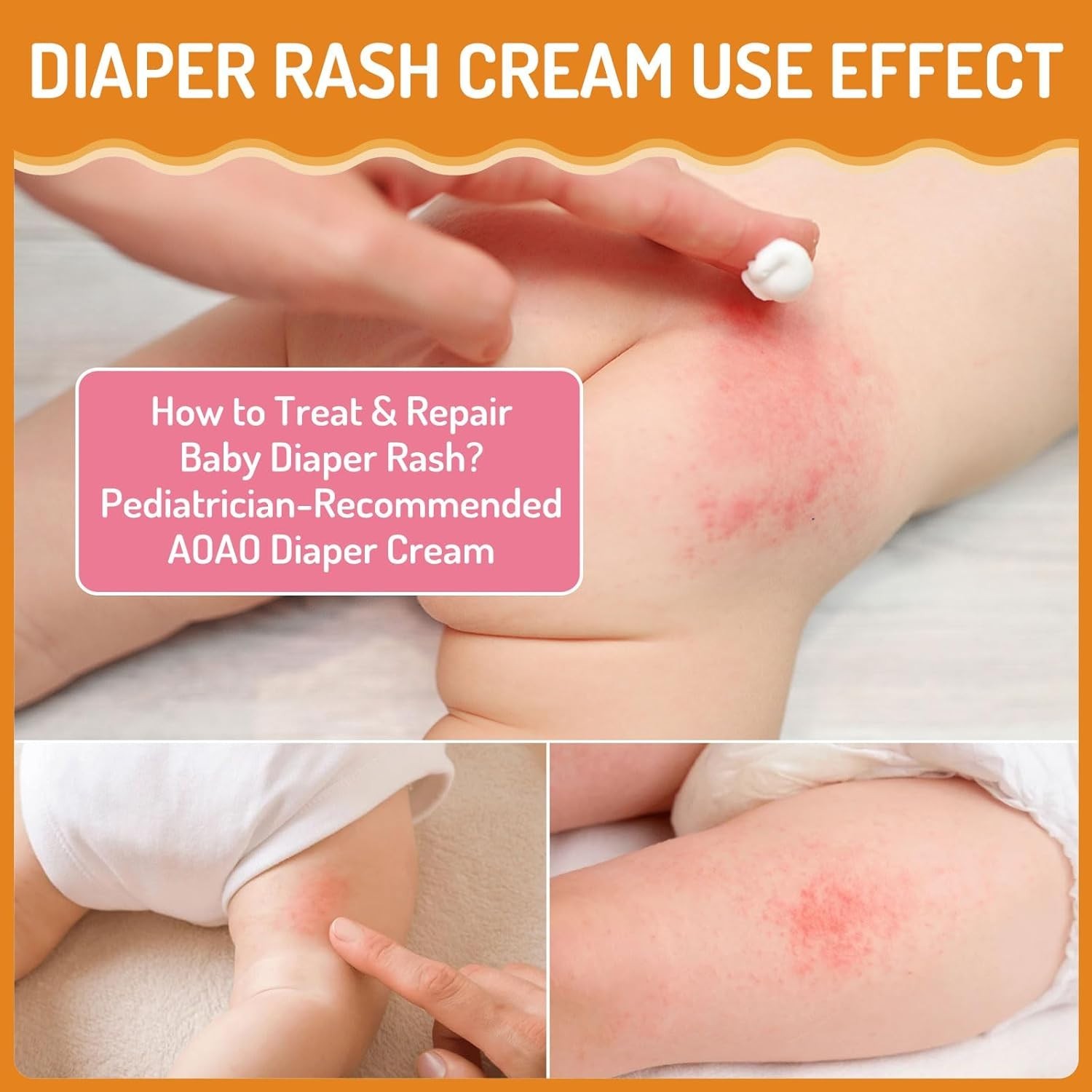 Baby Diaper Rash Cream with Zinc Oxide, Prevents & Heals Newborn Diaper Rash