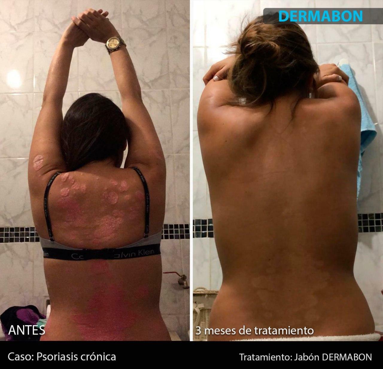 Psoriasis, Seborrheic Dermatitis and Dandruff Soap Dermabon FREE SHIPPING