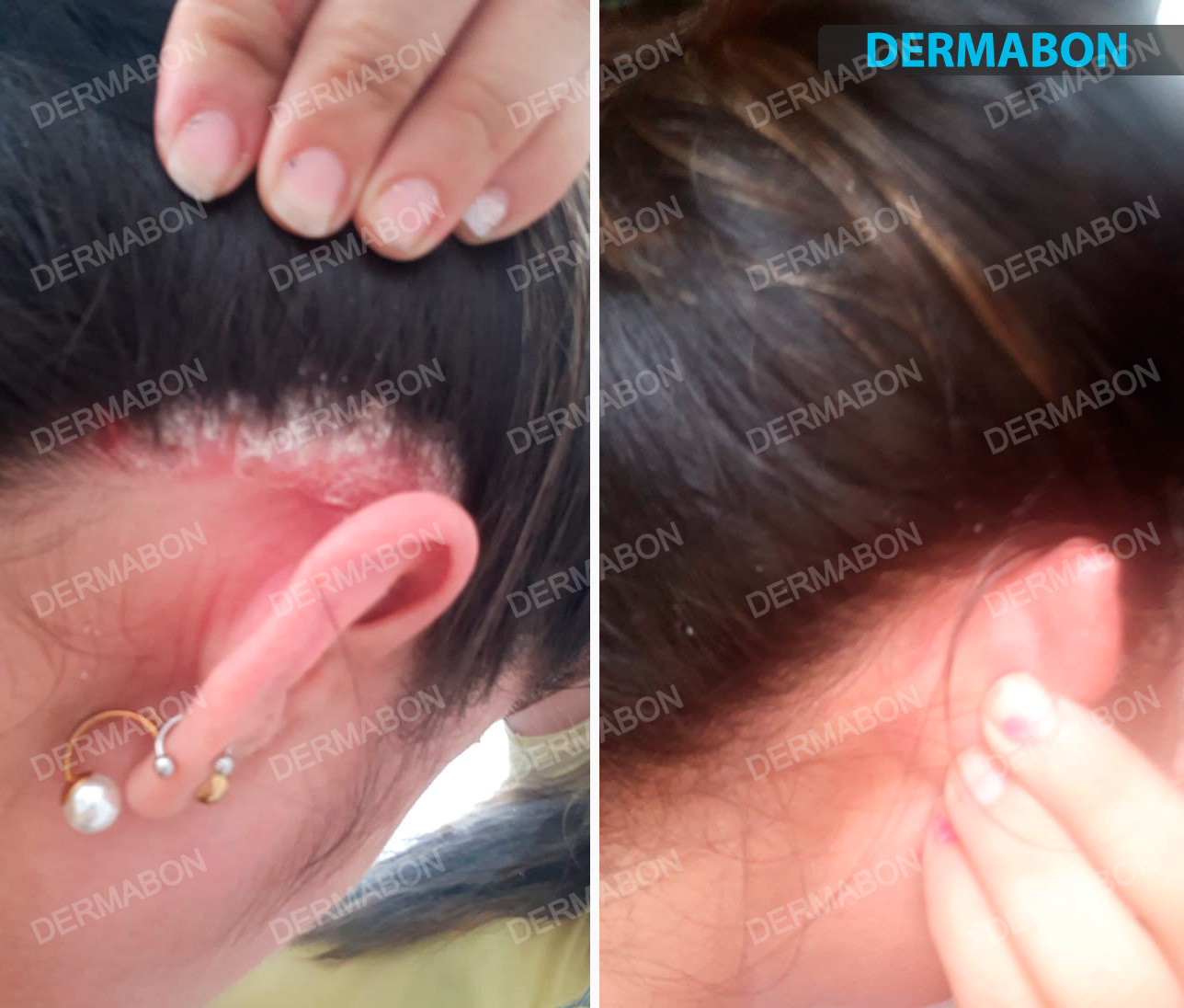 Dandruff Psoriasis Seborrheic Dermatitis 3 Pack Dermabon natural