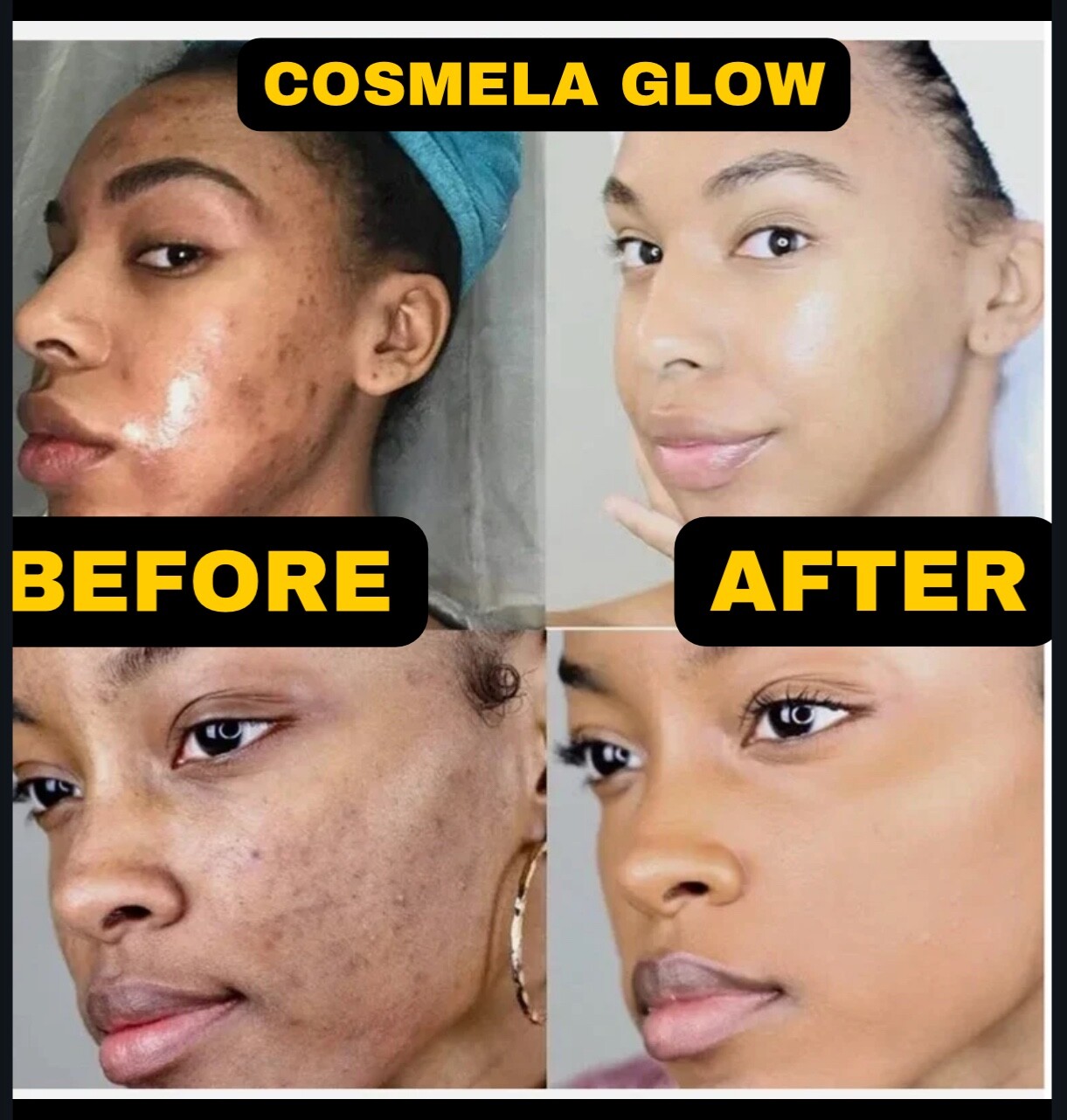 Turmeric Soap Skin Whitening Dark Spots Lightening Acne Brightening Tumeric