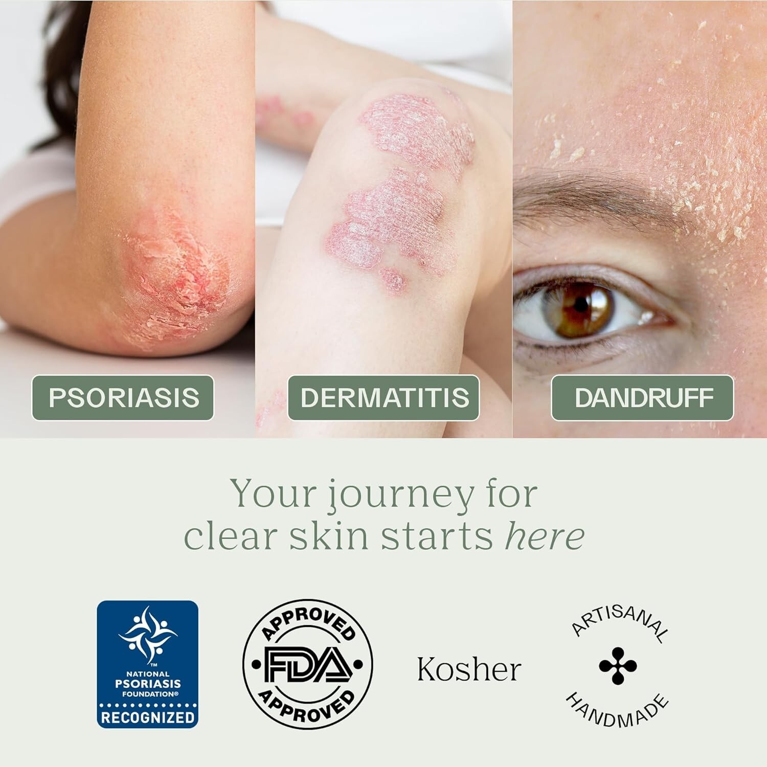 Gentle Coal Tar Soap Bar for Psoriasis Relief – 2% Active Ingredients, 3.2 oz
