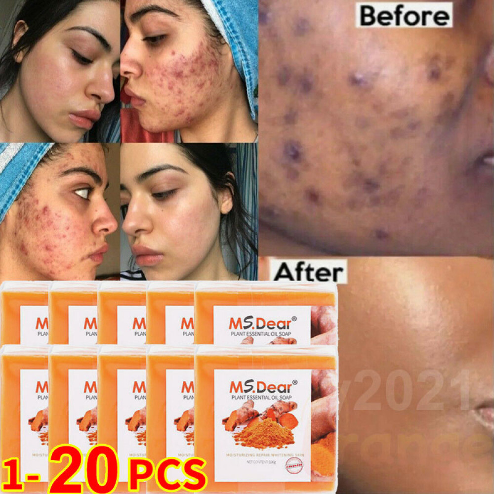 20X Tumeric Soap Skin Whitening Dark Spots lightening Acne Brightening Turmeric
