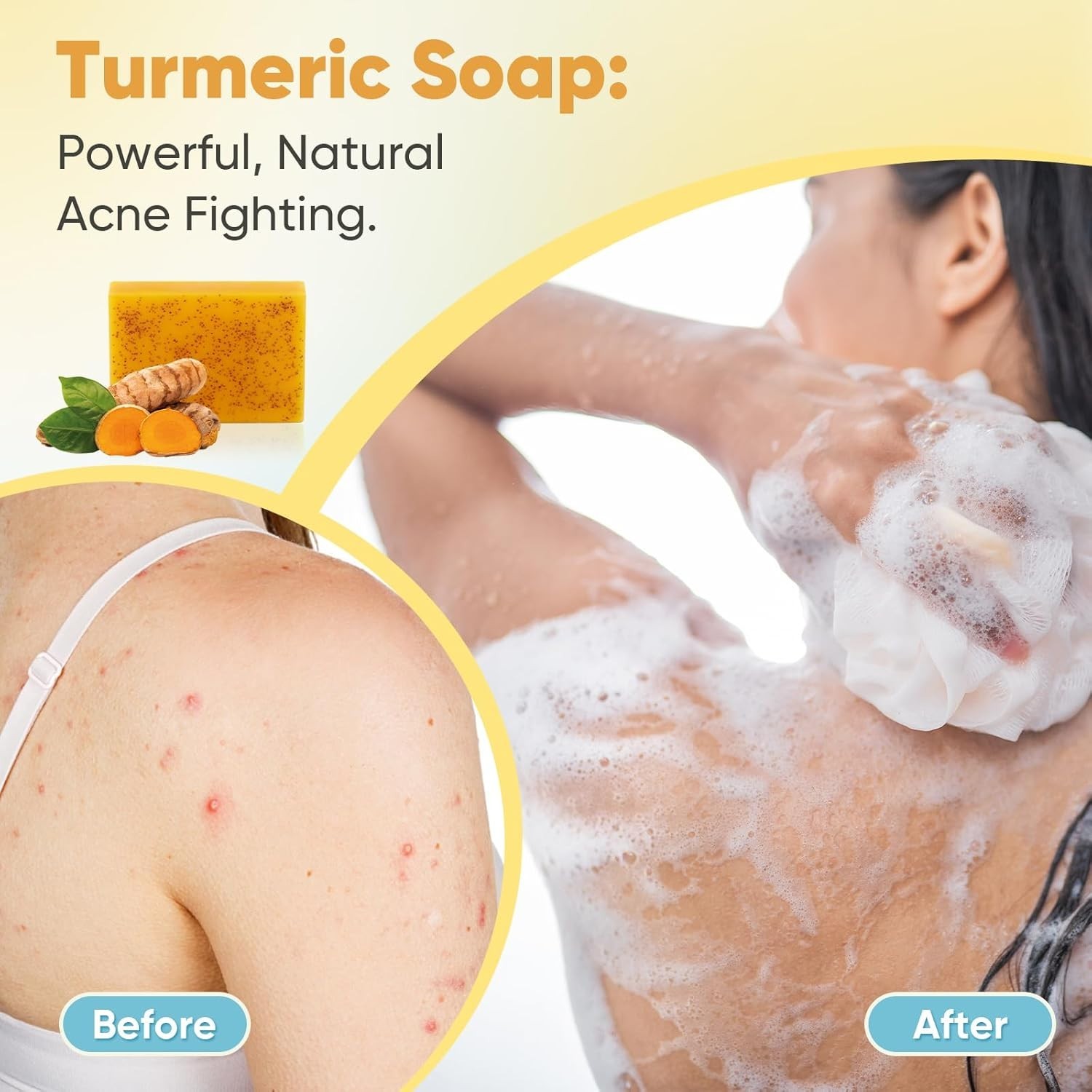 Treeroot 5 Pack Turmeric Soap, 80g Kojic Acid and Turmeric Soap Bar, Gently Cle