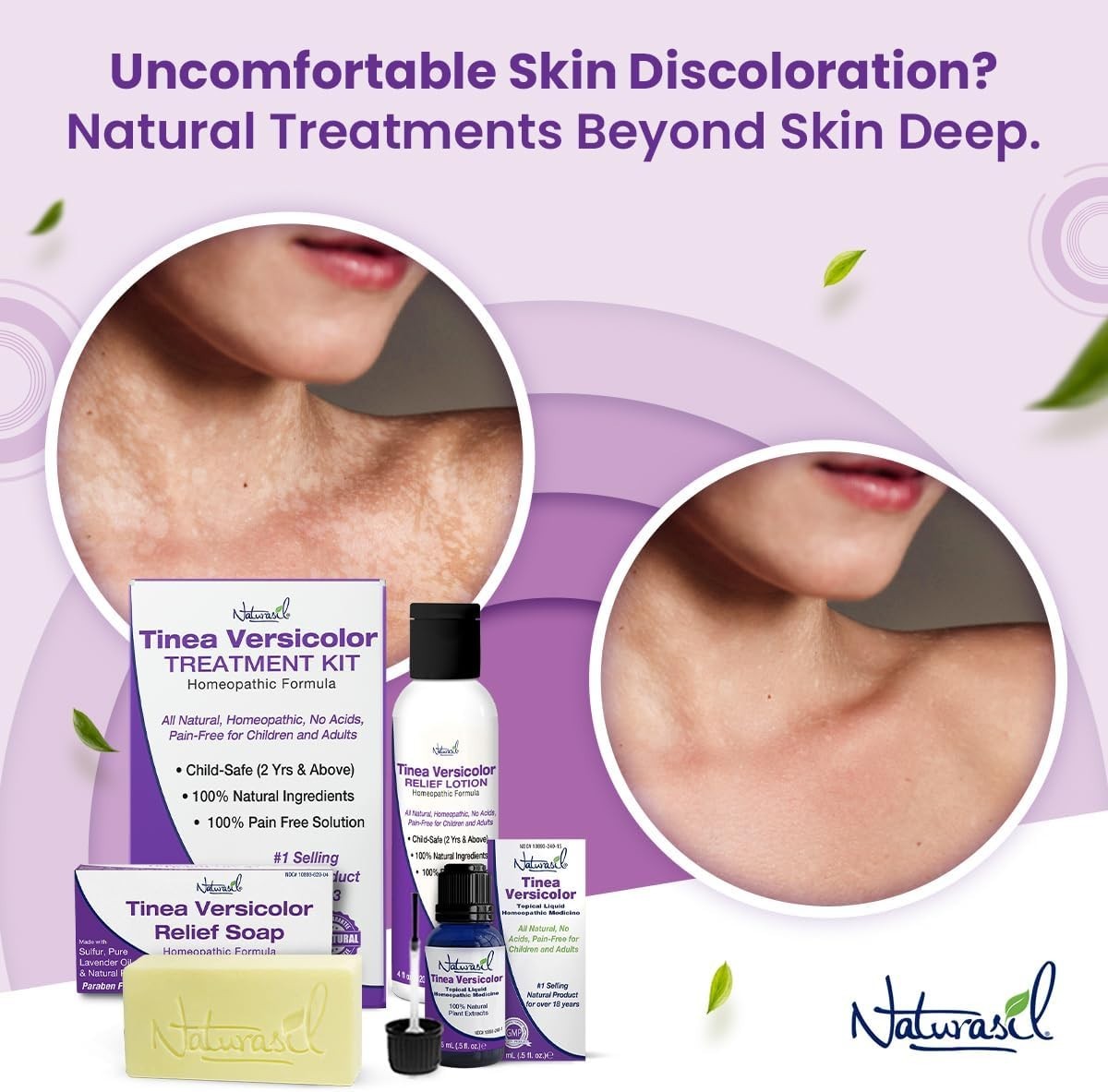Max-Strength Tinea Versicolor Soap – Fast-Acting Antifungal Relief for All Ages