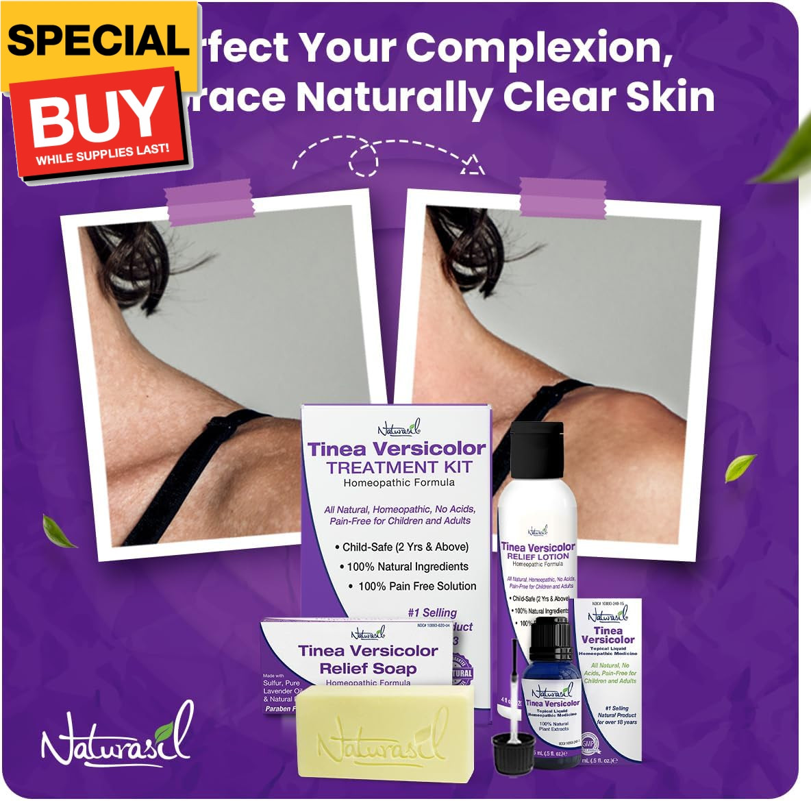 Tinea Versicolor Treatment Max-Strength 10x Soap | Antifungal Micronized Sulfur