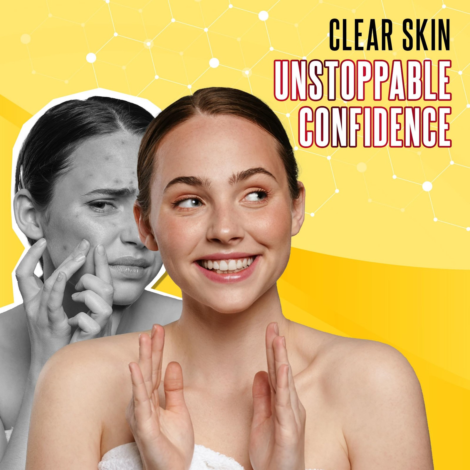 Grisi Acne Treatment Soap Deep Cleansing, AcneFighting, Reduces Inflammation,…