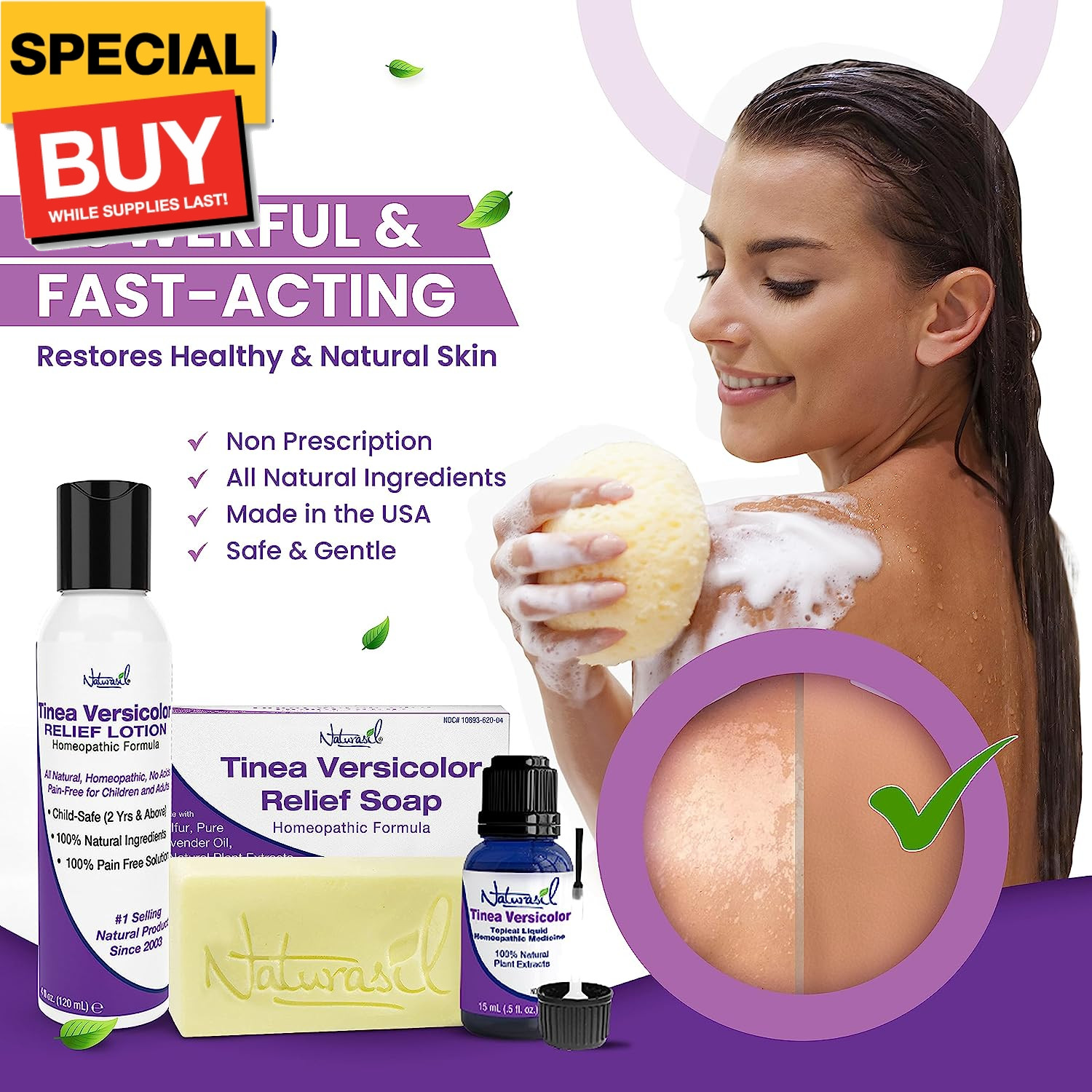 Tinea Versicolor Treatment Max-Strength 10x Soap | Antifungal Micronized Sulfur