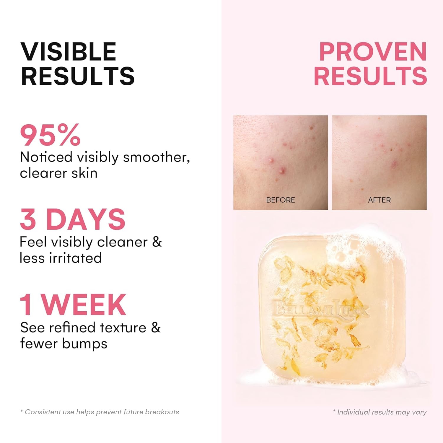 Body Acne Soap Bar Antibacterial Bar for Butt, Thighs, Back, Body Acne, Folli…