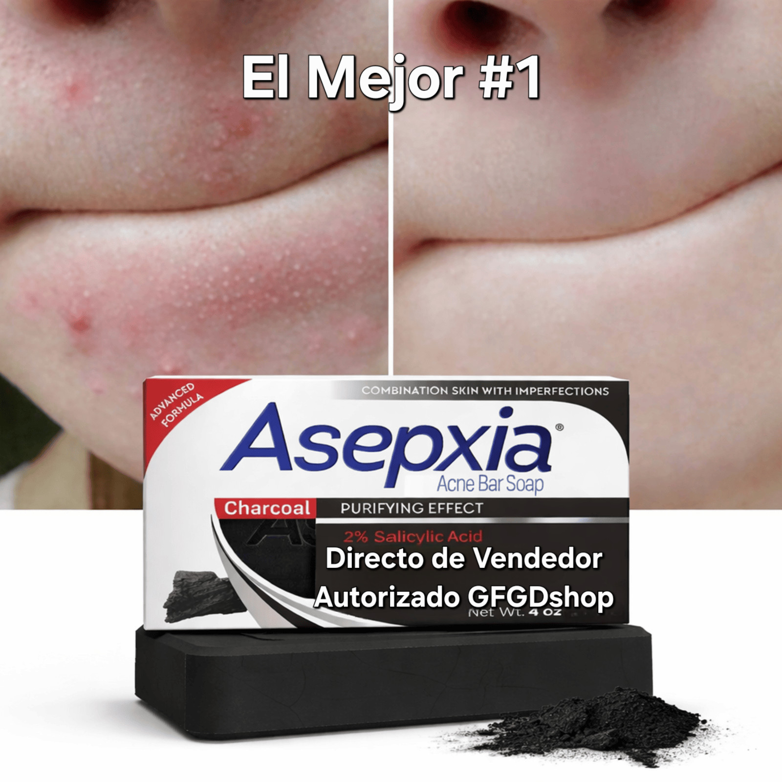 #1 Mejor Jabon Para Eliminar El Acne Y Espinillas Grasa Aclarar La Cara La Piel